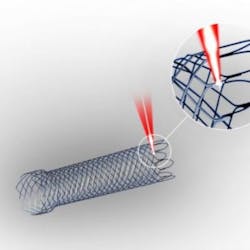 Laser welding and laser cutting are robust, cost-effective production processes for stent manufacturing. Laser welding and laser cutting are robust, cost-effective production processes for stent manufacturing.