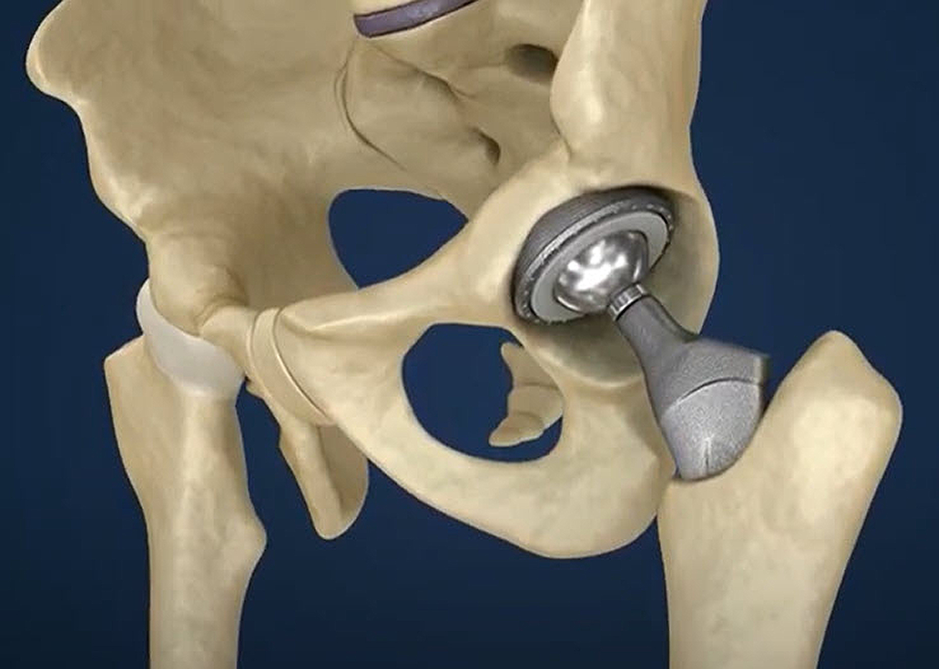 Figure 1: An orthopedic hip implant shown with a femoral ball.