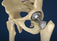 Orthopedic hip