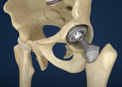 Figure 1: An orthopedic hip implant shown with a femoral ball. Figure 1: An orthopedic hip implant shown with a femoral ball.