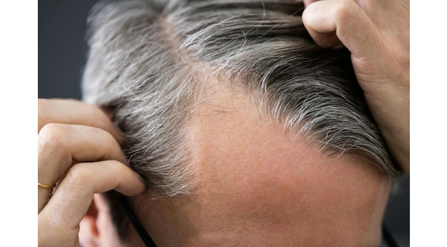 Strand by Strand, Robots Are Changing Painful Hair Loss Treatments